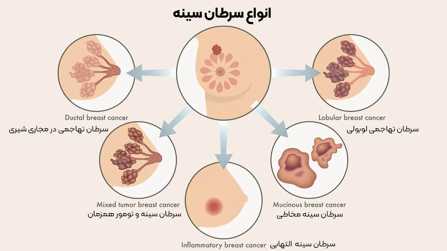 انواع سرطان سینه